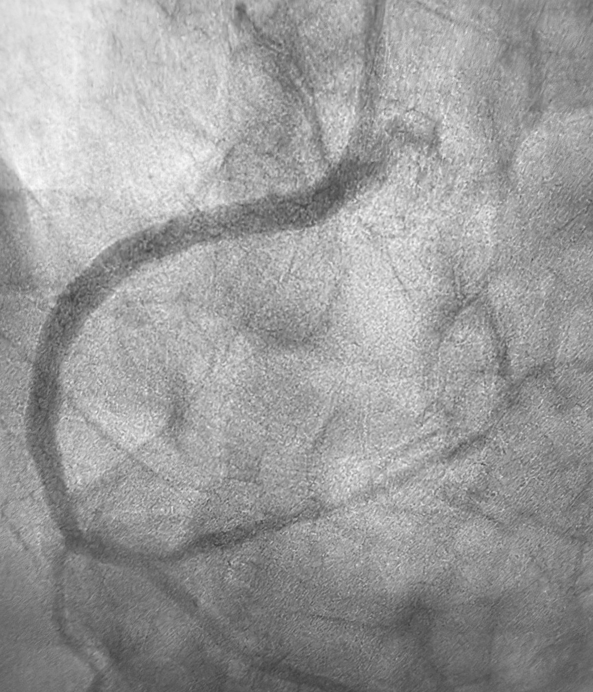 Angiografia coronária mostrando a coronária direita reaberta após angioplastia, com fluxo restabelecido em toda a artéria