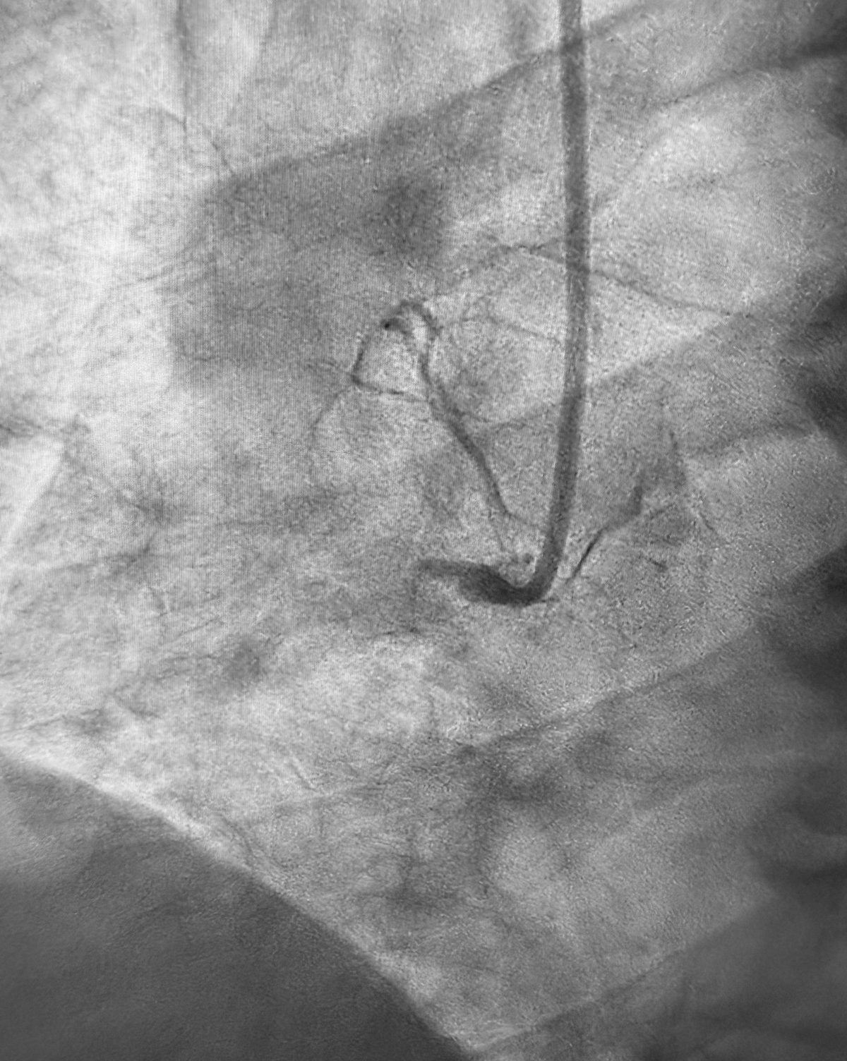 Angiografia coronária mostrando a coronária direita ocluída durante um infarto: o contraste para no ponto da obstrução