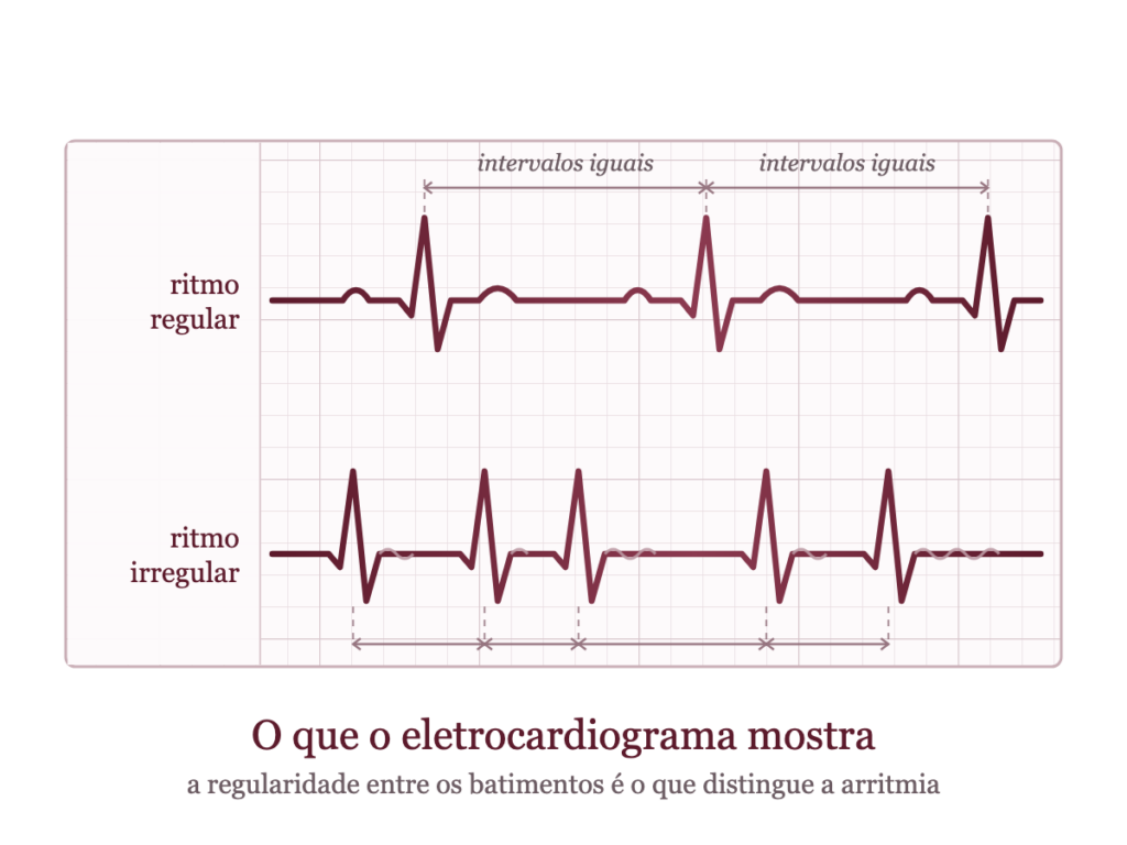 Traçado de eletrocardiograma comparando ritmo regular e irregular