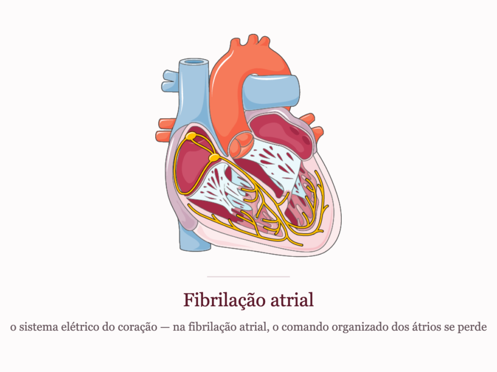Sistema de condução elétrica do coração em corte frontal, base da compreensão da fibrilação atrial