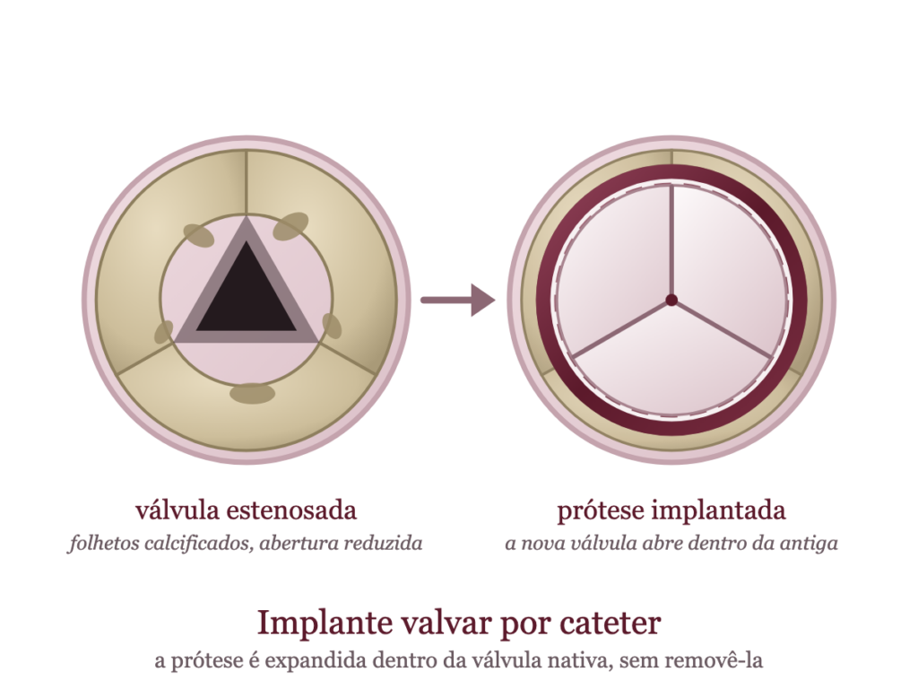 Válvula aórtica estenosada e prótese implantada por cateter