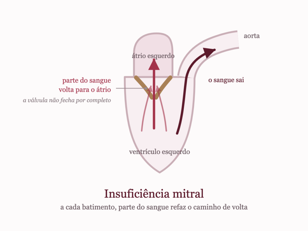 Esquema do átrio e do ventrículo esquerdos com folhetos mitrais que não fecham por completo e refluxo de sangue de volta ao átrio
