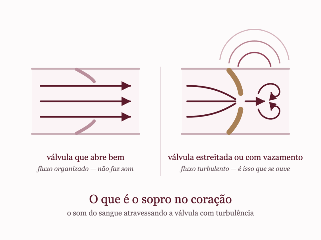 Comparação entre fluxo laminar por uma válvula que abre bem e fluxo turbulento por uma válvula estreitada, com ondas sonoras representando o sopro